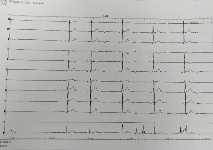 【罕见】局麻-针头刚刚刺破患者的皮肤,就心脏骤停了