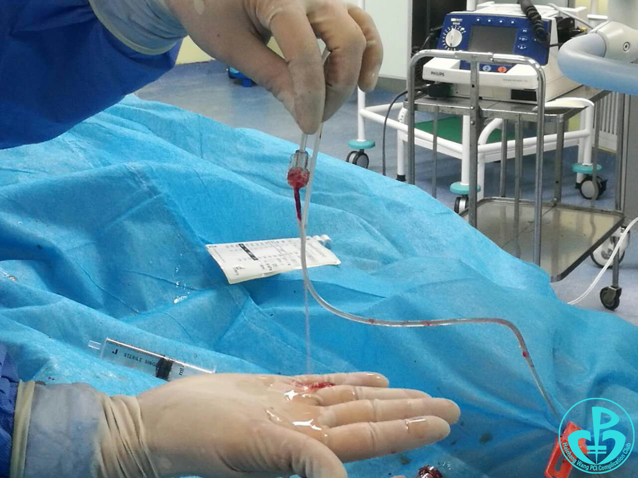 经典病例:意想不到的支架内血栓