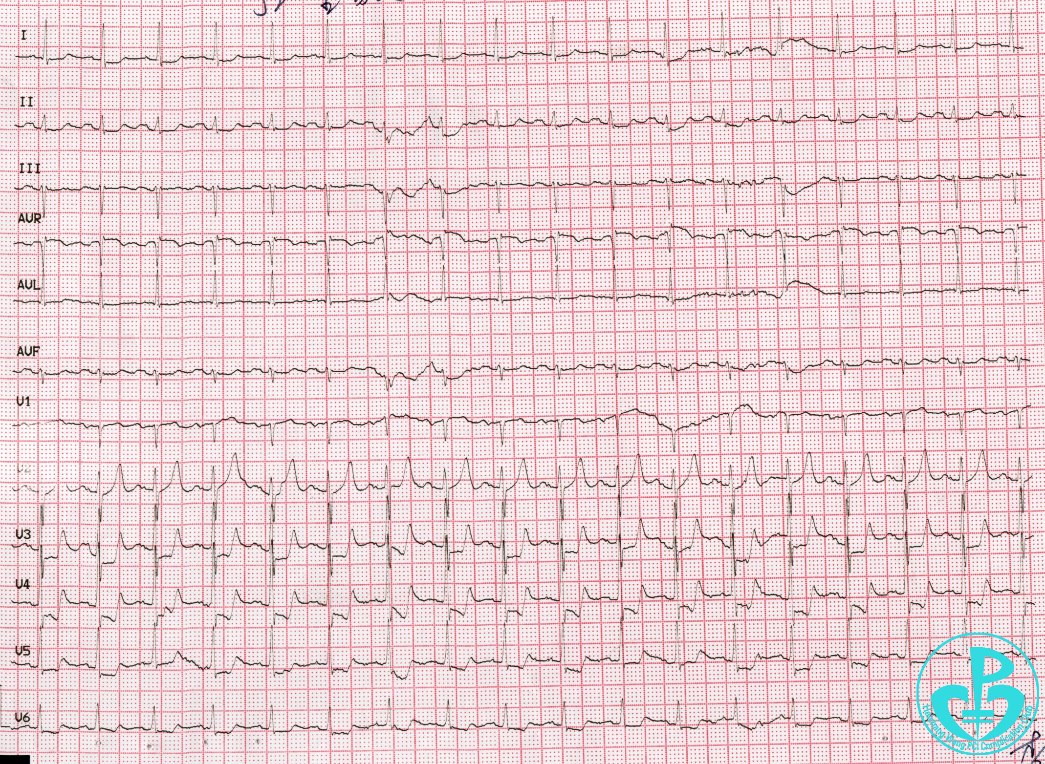 危重复杂冠心病患者pci成功一例